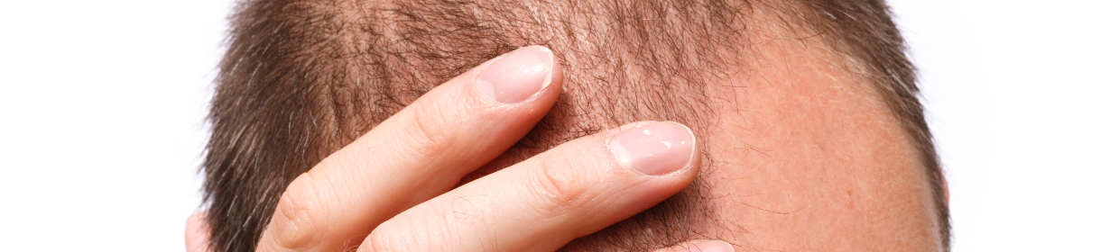 Haarausfall: Wie viel Haarverlust ist normal? | Health Travels