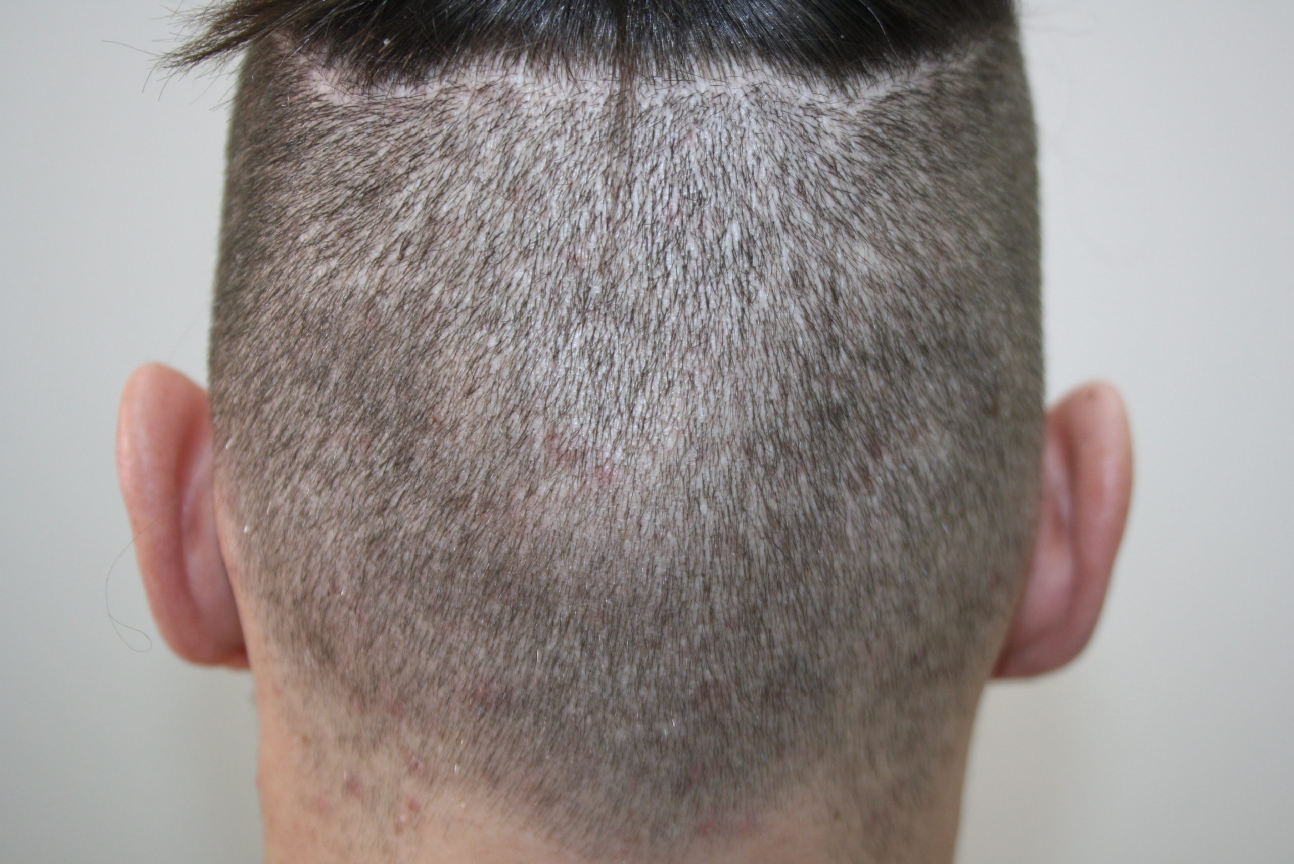 Narben Nach Haartransplantation Health Travels