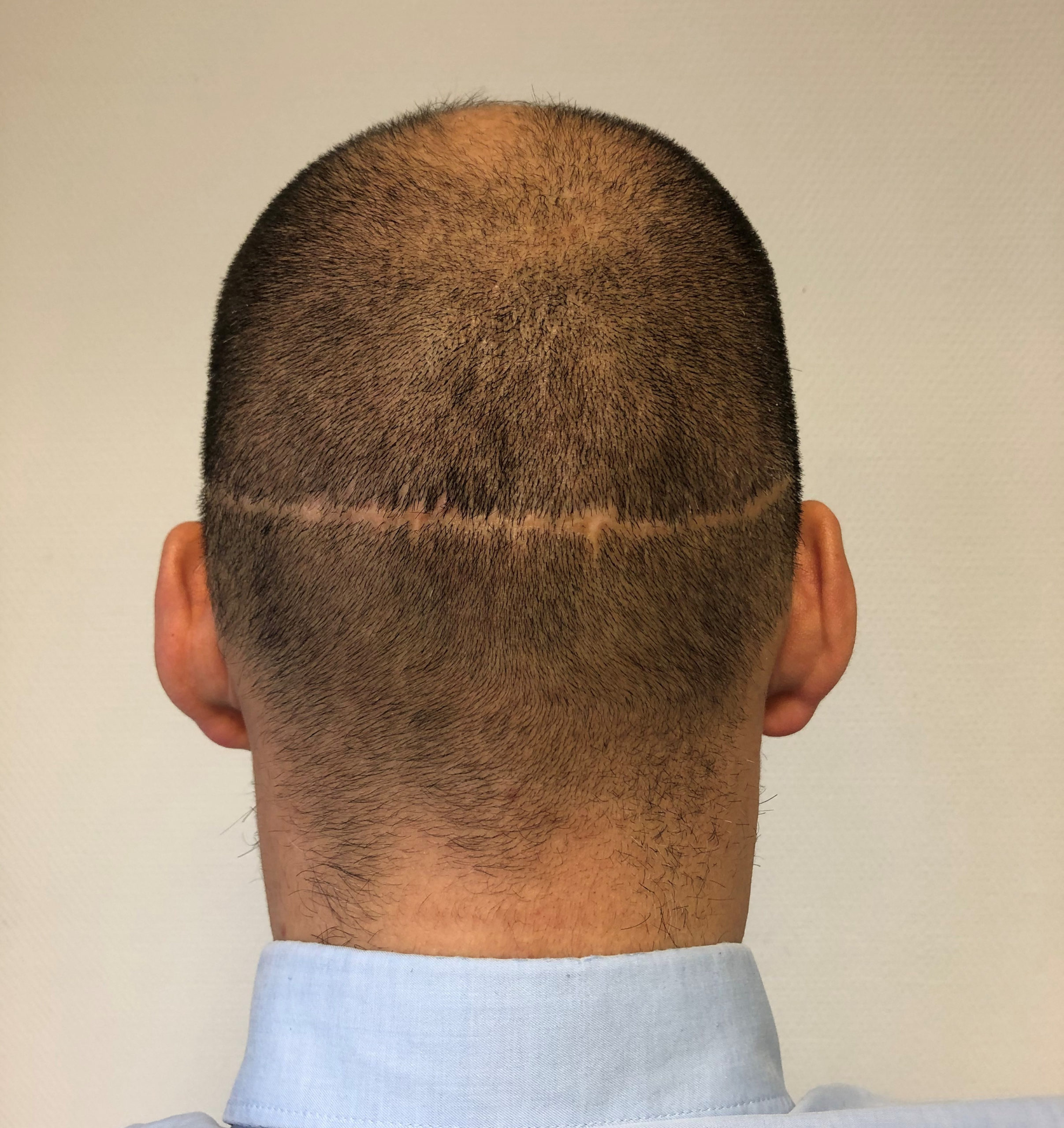 Narben Nach Haartransplantation Health Travels