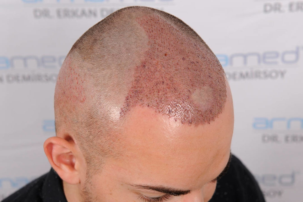 Haartransplantation Post-OP Verlauf